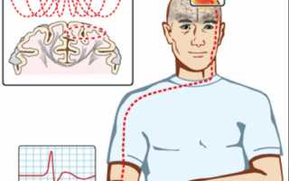 Транскраниальная магнитная стимуляция мозга: показания и особенности проведения процедуры