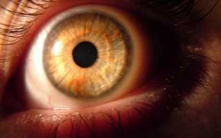 Факоморфическая и факолитическая глаукома