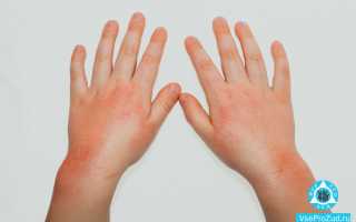 Красные пятна на руке чешутся: причины, лечение, фото