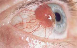 Злокачественная опухоль глаза: виды, симптомы, лечение