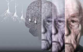 Как долго живут с последней стадией болезни Альцгеймера