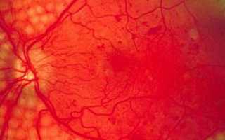 Диабетическая ретинопатия