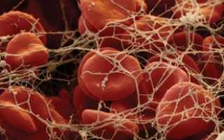 Что показывают результаты анализов крови на протромбин и фибриноген  и почему это важно для диабетика?