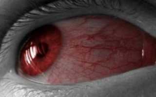 Красные белки глаз – что делать?